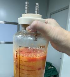 白沙水动力吸脂手术要做多久？